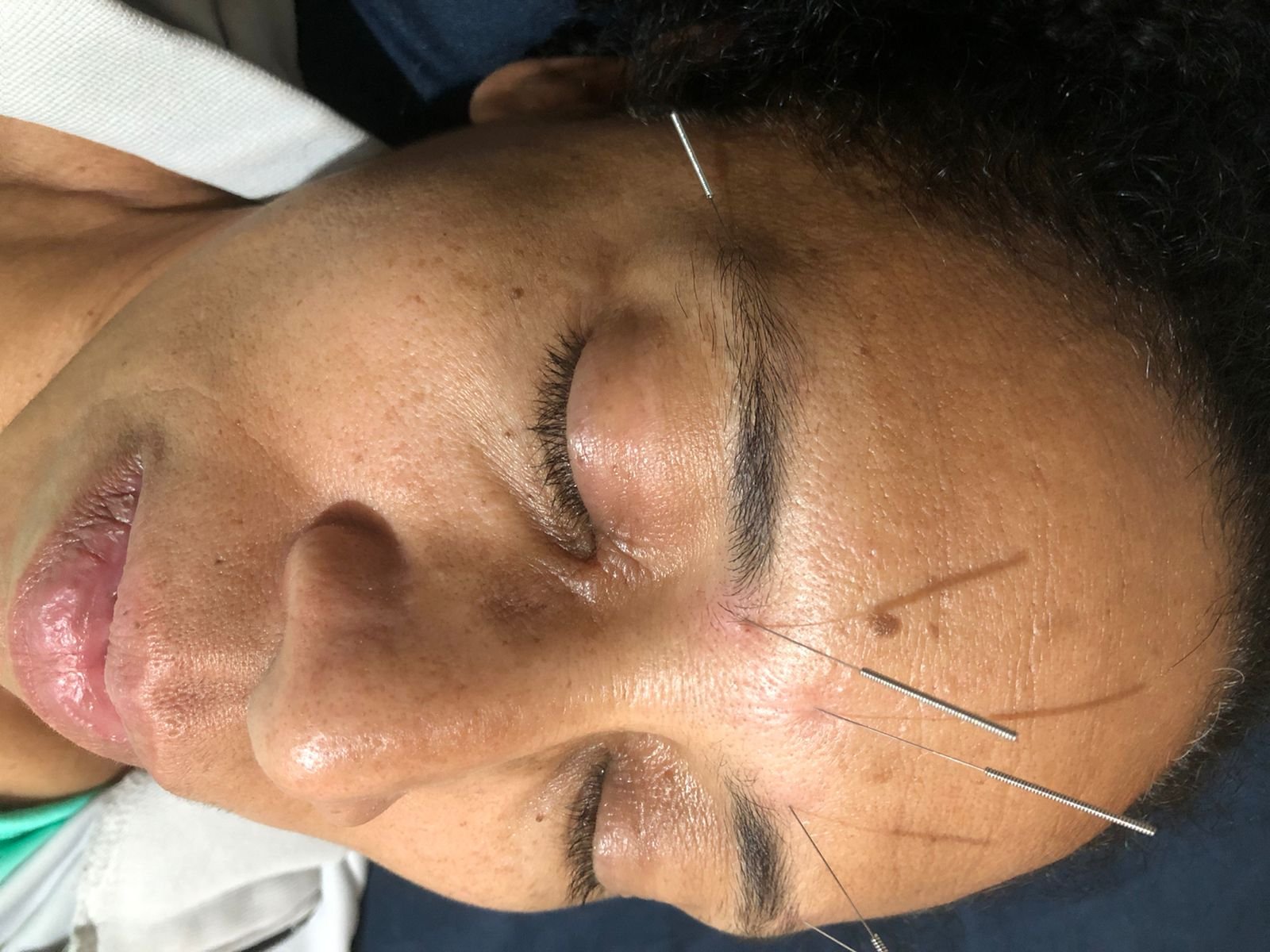 Acupuntura Facial